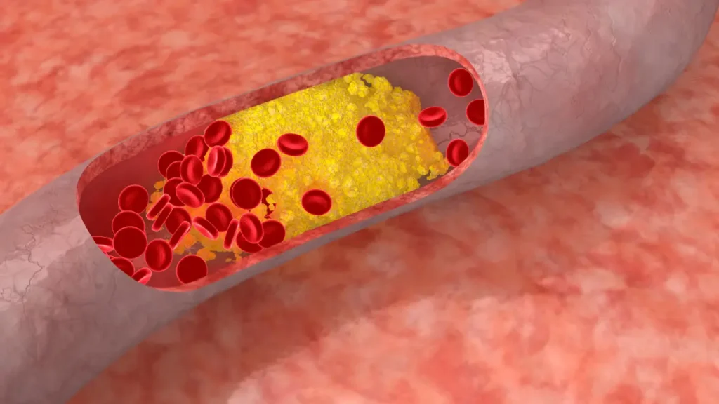 Colesterol alto pode significar risco além do imaginado
